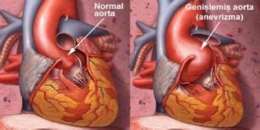 aort damarı normalde kaç cm olmalı